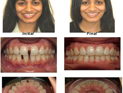 Orthodontics in Dentist in NYC cosmeticdentistbrooklyn.com Advanced Dental Care Advanced Dental Care of NYC 718-624-1970